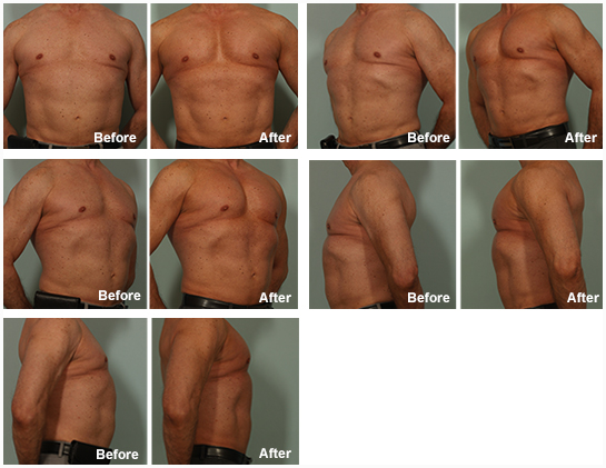 PectoralImplants